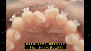 部分矯正による歯のガタガタ、反対咬合（叢生）治療にて、隙間がないのでバネで押し広げます。